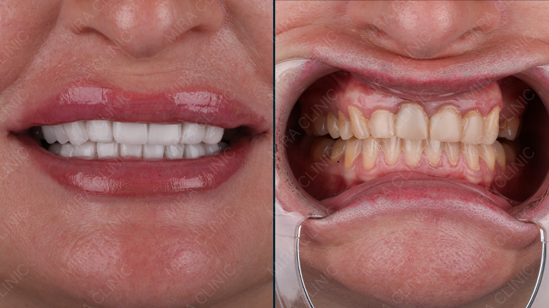 Hollywood smile Before and after 